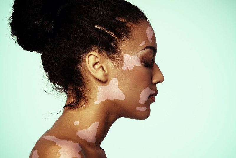 Terapia Tópica com Tacrolimus no Vitiligo Facial